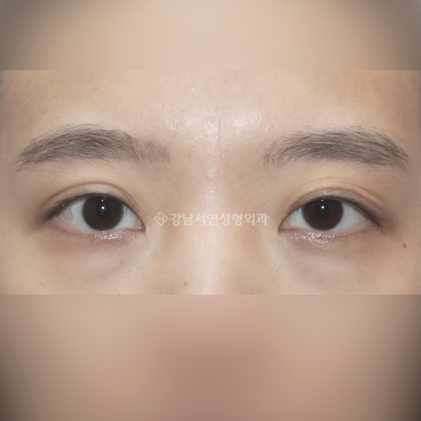 비대칭 교정 BEFORE
