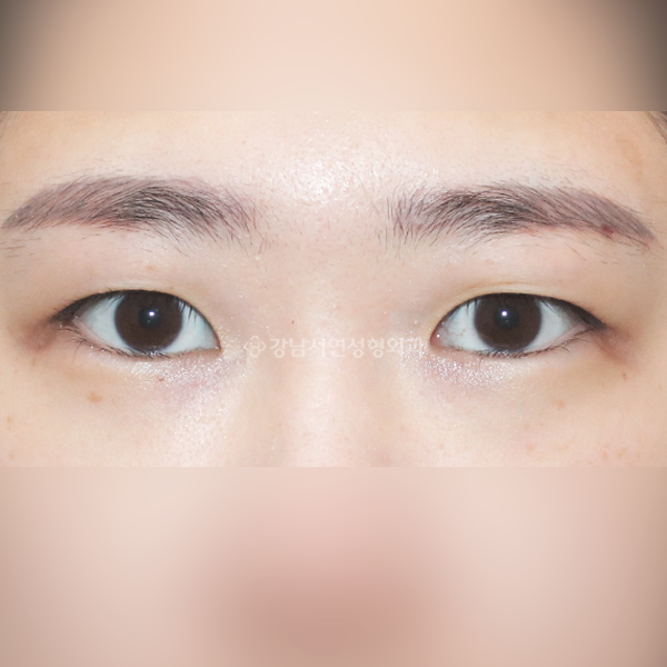 절개 쌍꺼풀 BEFORE