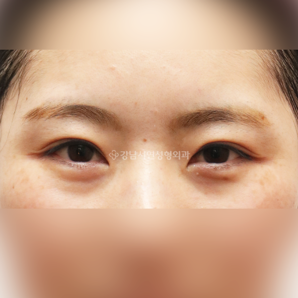 쌍꺼풀 재수술 BEFORE