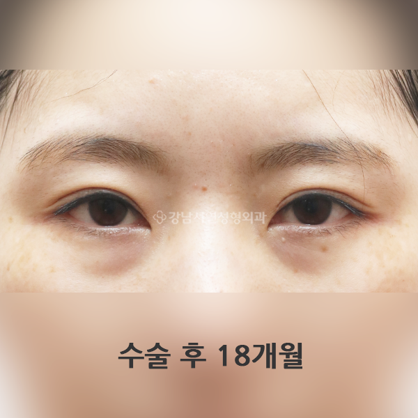 쌍꺼풀 재수술 AFTER