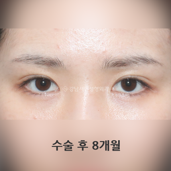 절개쌍꺼풀+앞트임 AFTER