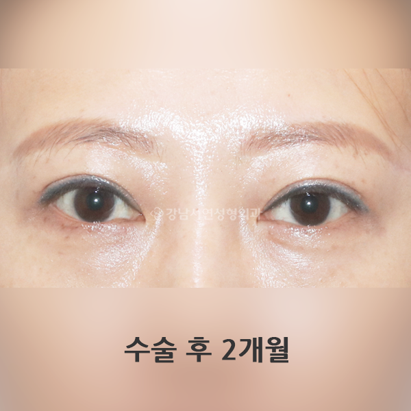 상안검 AFTER