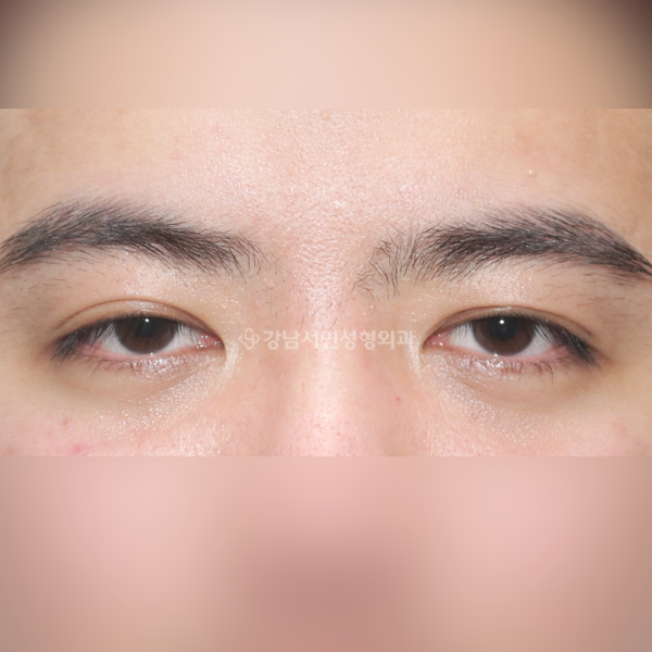 절개 쌍꺼풀 재수술(두줄따기) BEFORE