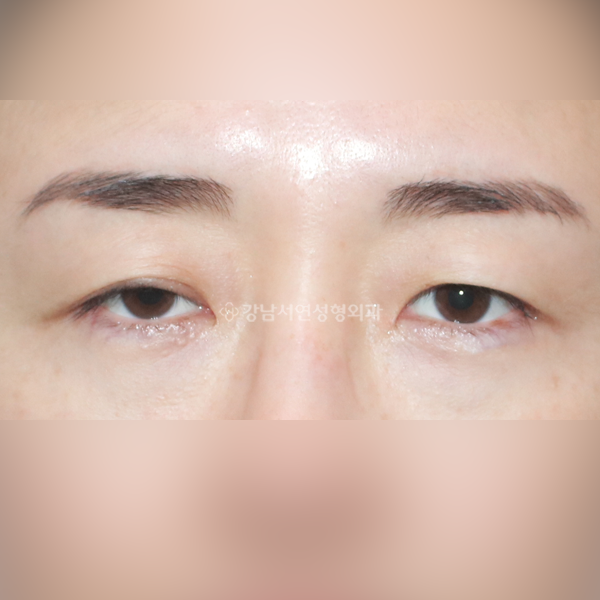 짝눈 교정 BEFORE