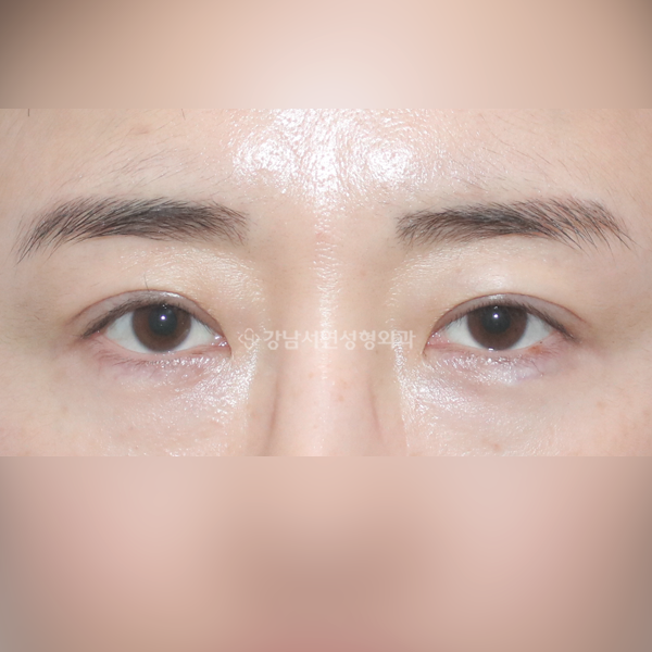 짝눈 교정 AFTER