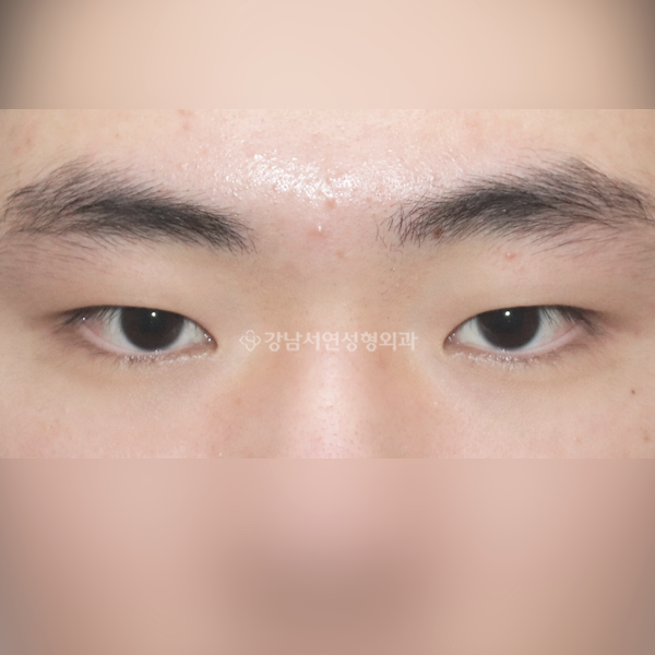 남자 무쌍(속쌍)눈매교정 BEFORE