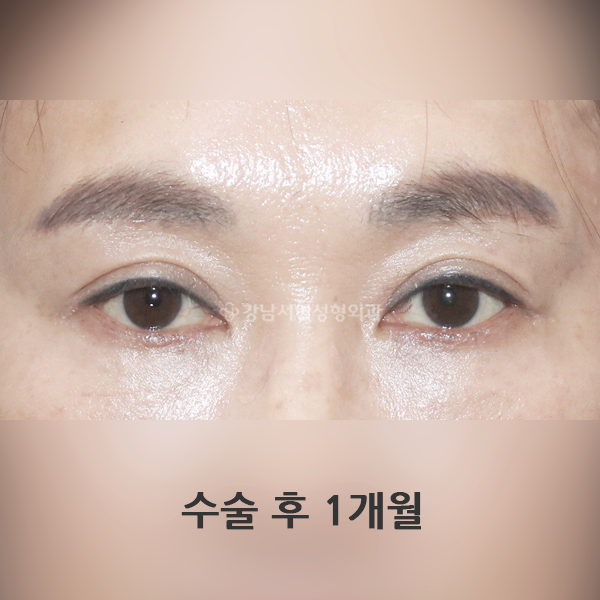 눈썹하거상 AFTER