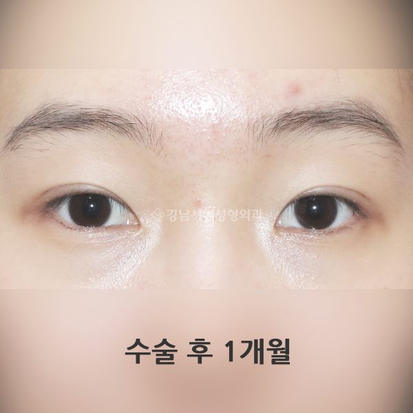 매몰 쌍꺼풀 AFTER