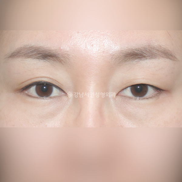 상안검 BEFORE