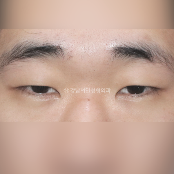 남자 무쌍(속쌍)눈매교정 + 앞트임 BEFORE