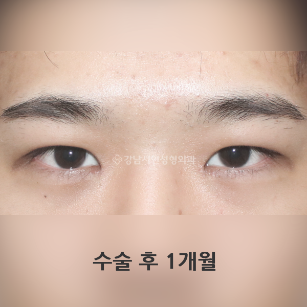 남자 무쌍눈매교정 AFTER