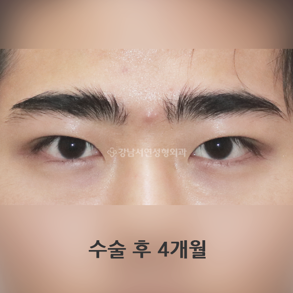 남자 무쌍(속쌍)눈매교정 AFTER