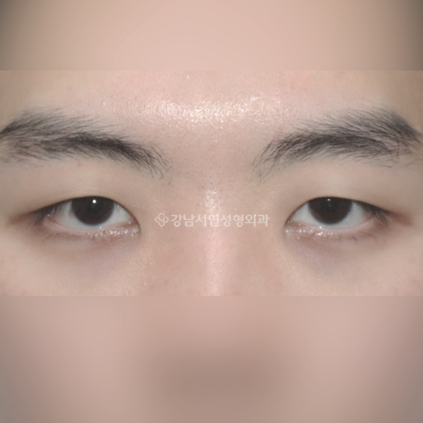 남자 무쌍눈매교정 BEFORE