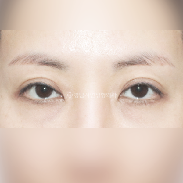 절개 쌍꺼풀 재수술 BEFORE