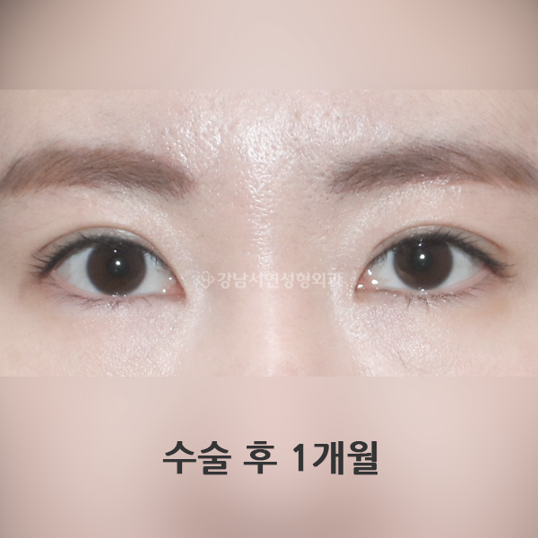 상안검+앞트임 AFTER