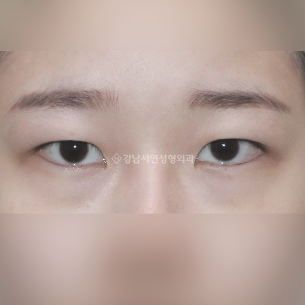 매몰 쌍꺼풀 BEFORE