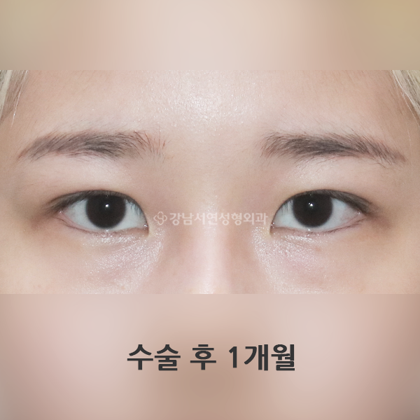 매몰 쌍꺼풀 AFTER