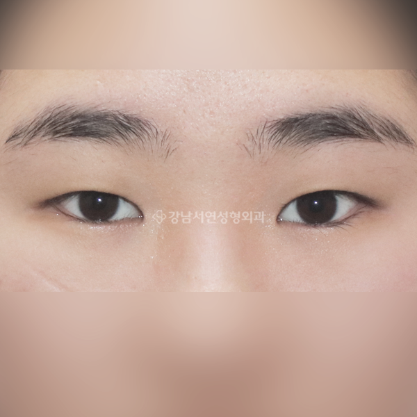 절개쌍꺼풀+앞트임 BEFORE