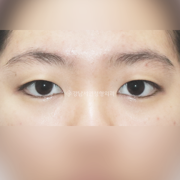 매몰 쌍꺼풀 BEFORE