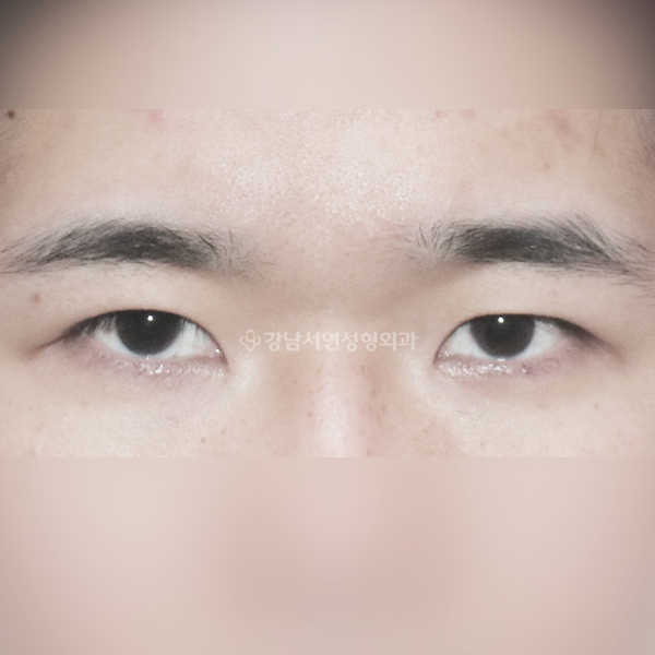 남자 무쌍눈매교정 AFTER