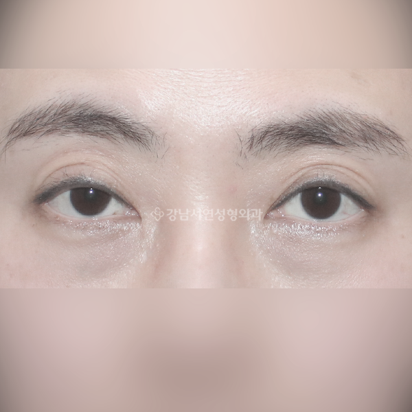 절개 쌍꺼풀 재수술 BEFORE