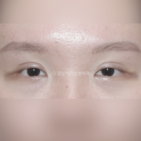 라인 낮추기 BEFORE