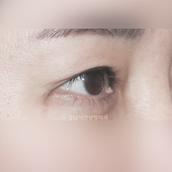 뒤트임 복원 BEFORE