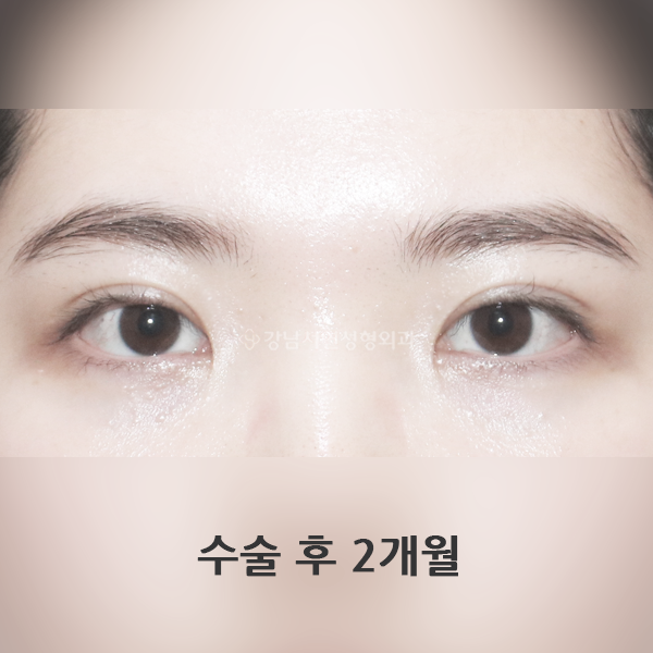 매몰쌍꺼풀+앞트임 AFTER