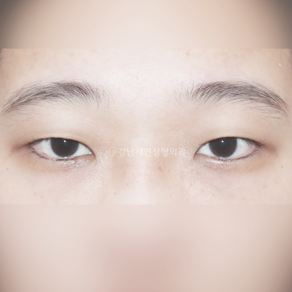 절개눈매교정+앞트임 BEFORE