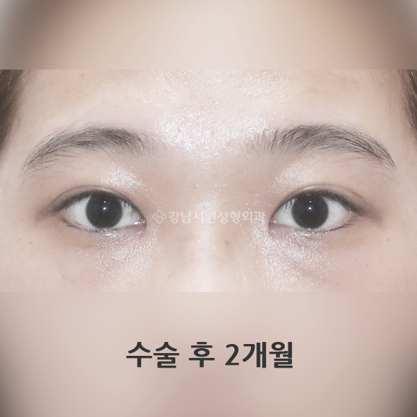 절개눈매교정+앞트임 AFTER