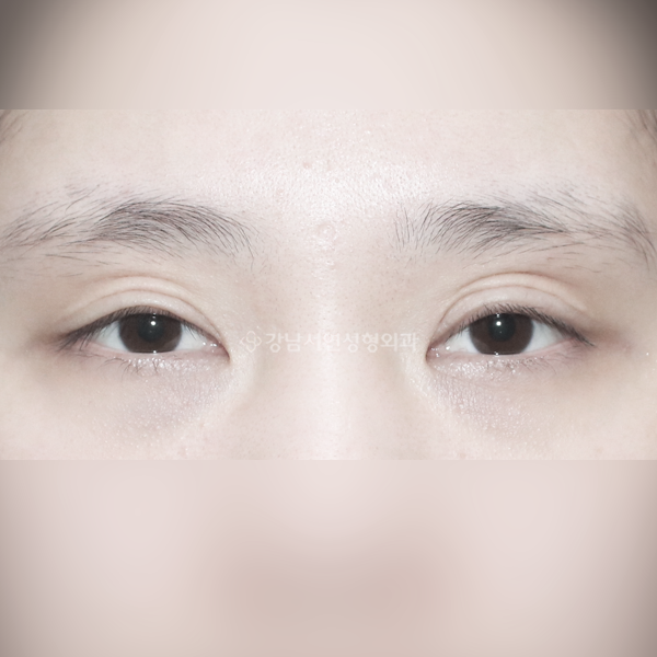 겹주름 개선 BEFORE