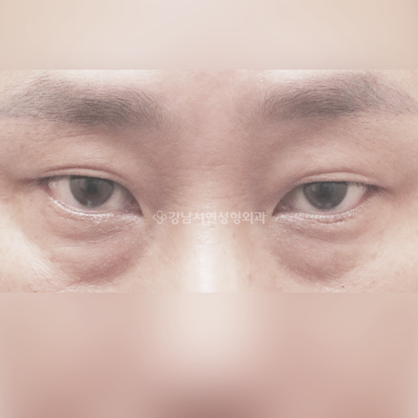 남자 무쌍눈매교정 + 눈밑지방재배치 BEFORE
