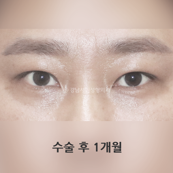 남자 무쌍눈매교정 + 눈밑지방재배치 AFTER