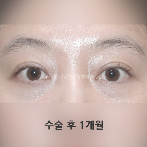 절개쌍꺼풀 AFTER
