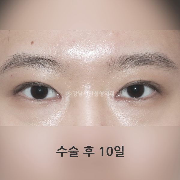 두줄따기 라인 낮추기 AFTER