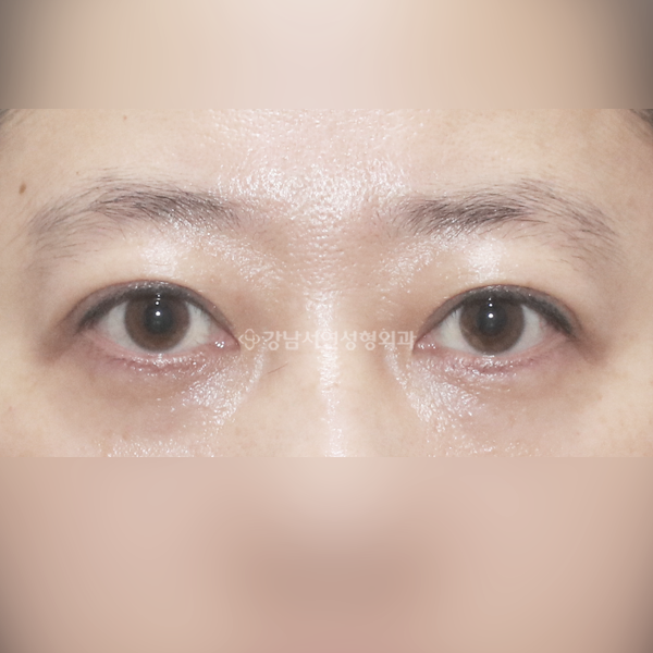 절개 쌍꺼풀 재수술 AFTER