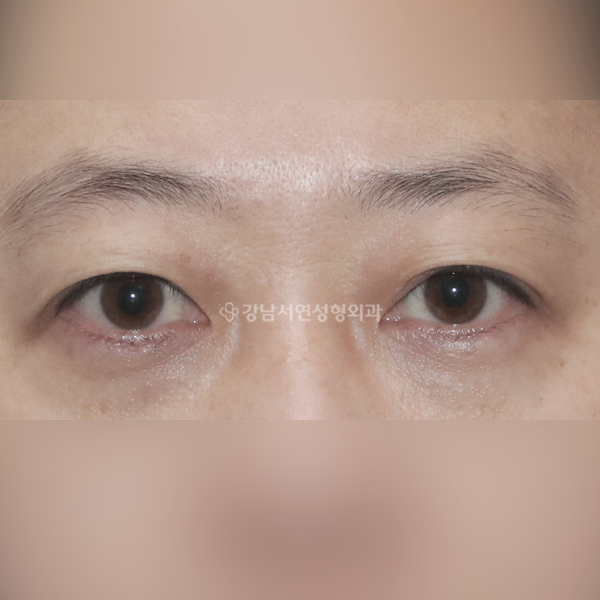절개 쌍꺼풀 재수술 BEFORE