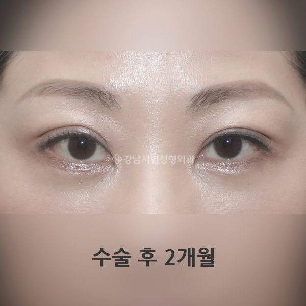 상안검 하안검 AFTER