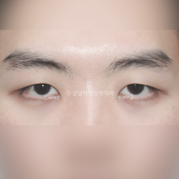 남자 무쌍눈매교정 BEFORE