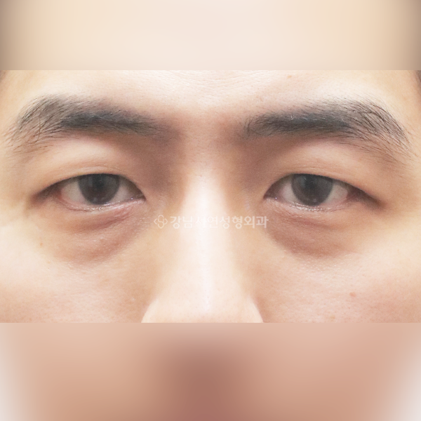 눈밑지방재배치 BEFORE