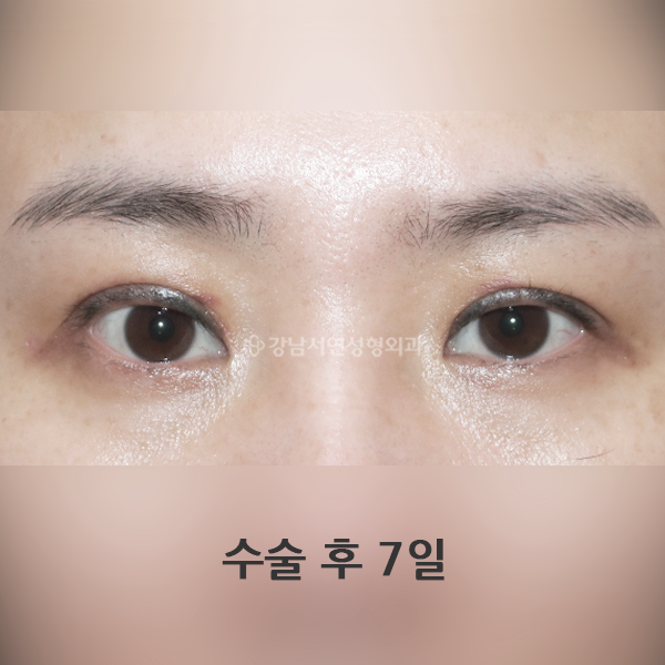 라인 낮추기 AFTER