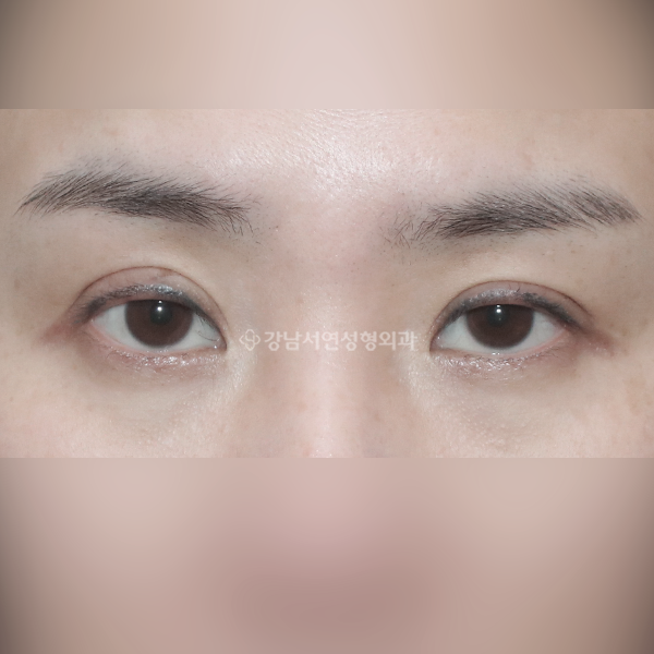 라인 낮추기 BEFORE