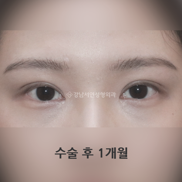 절개 쌍꺼풀 재수술 AFTER