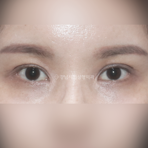 두줄따기 라인 낮추기 AFTER