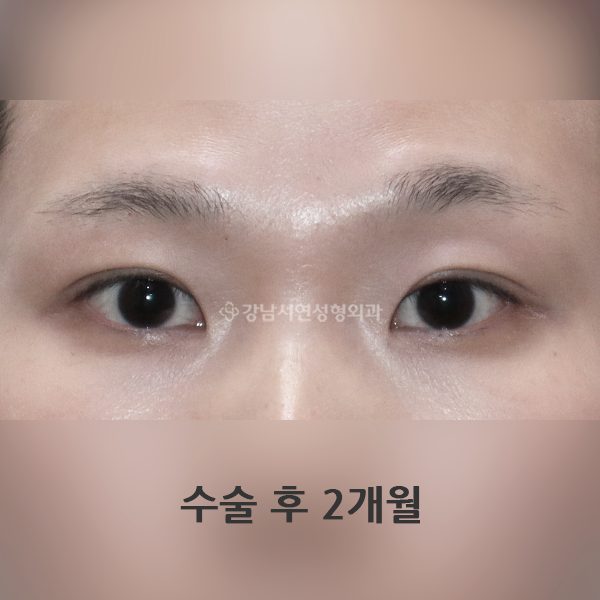 앞트임 + 절개쌍꺼풀(가성안검하수) AFTER
