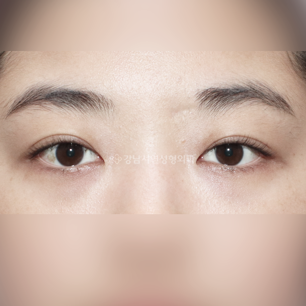 절개 쌍꺼풀 AFTER