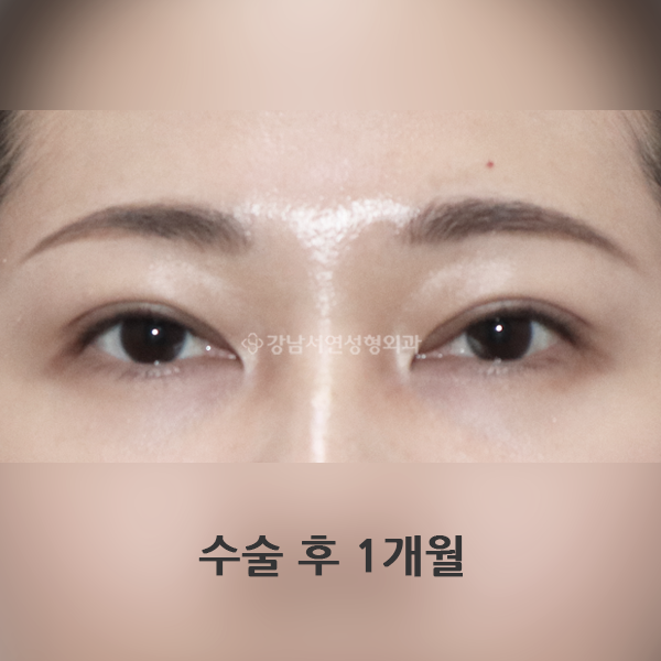 상안검 AFTER