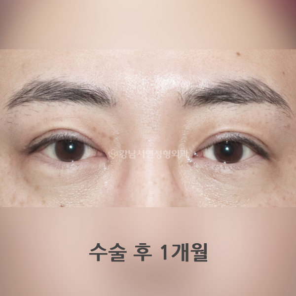 쌍꺼풀 재수술 겹주름 해결 AFTER