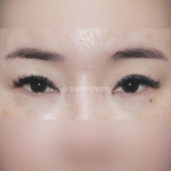 밑트임 BEFORE