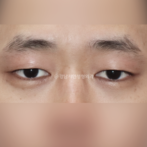 남자 무쌍(속쌍)눈매교정 BEFORE